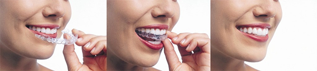 Red Bank Invisalign Dentist