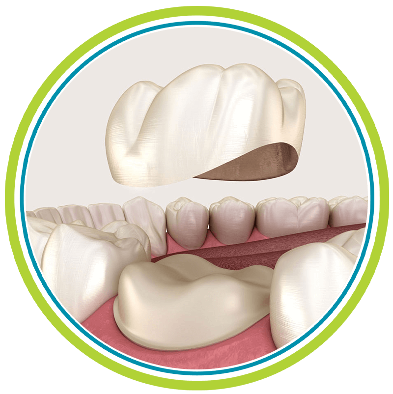 dental crown light cir