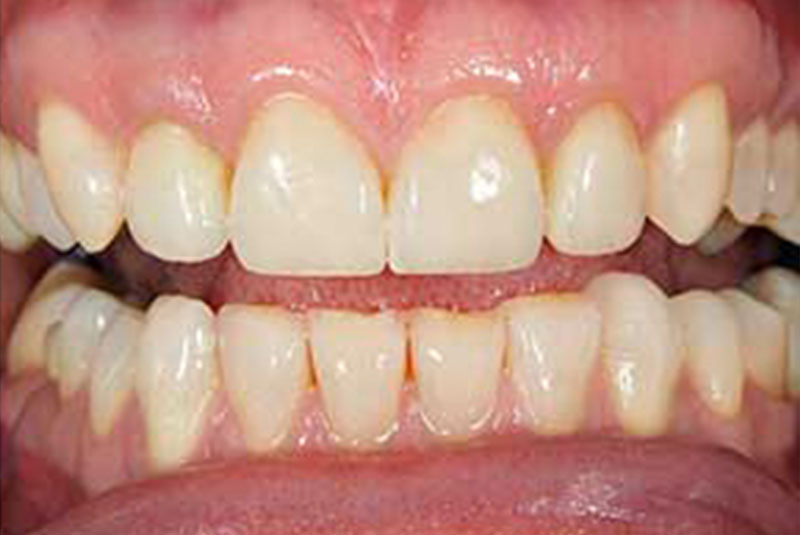 ba 2 after