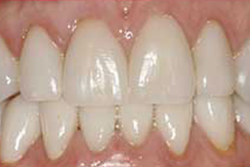 ba 4 after