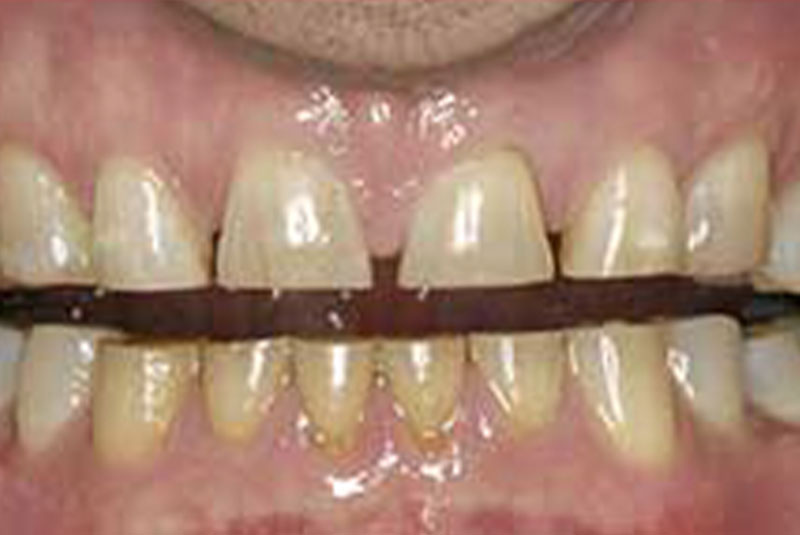 ba 4 before