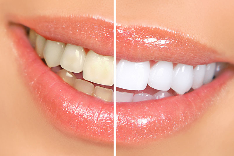 ba whitening side tilt