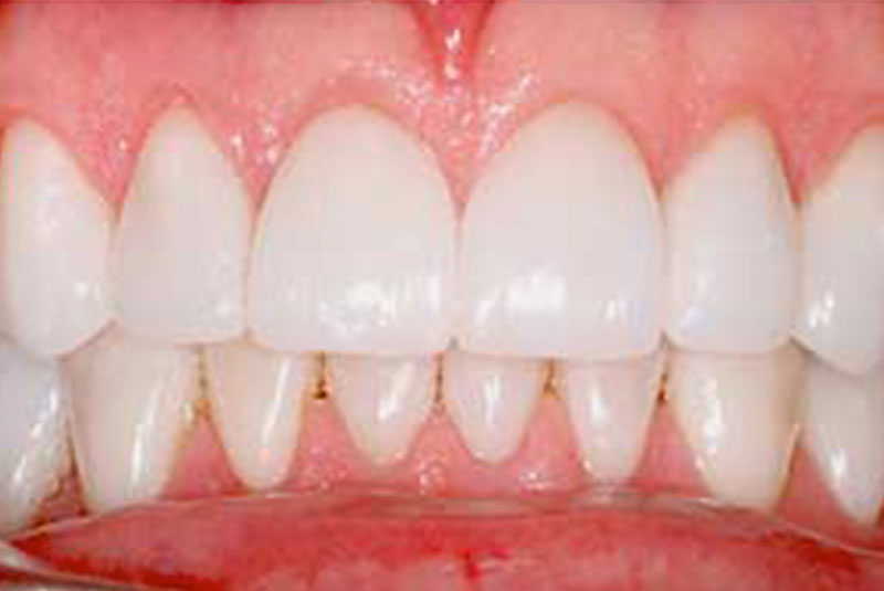 case 5 after