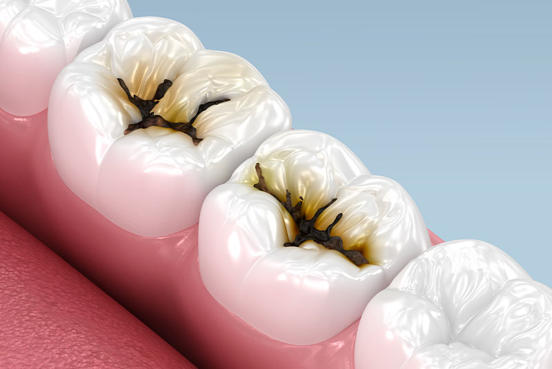 cavity decay tooth