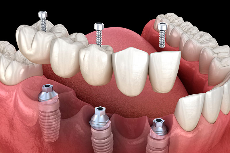 dental bridge with implants and screws
