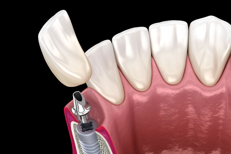 dental implant with bone 3d