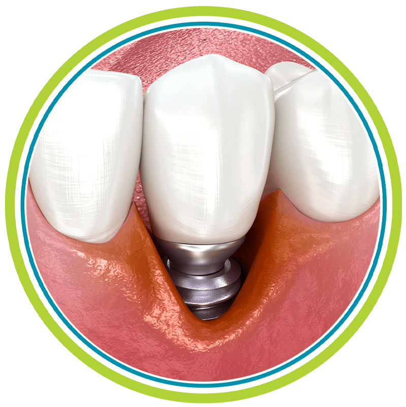 dental implant failure