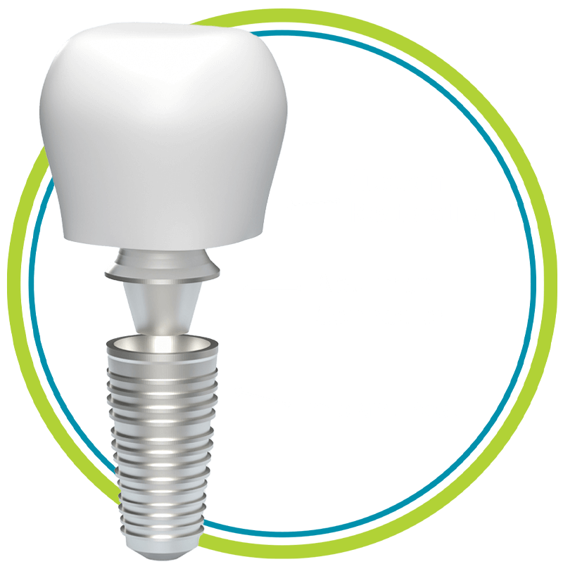 3 parts dental implant white