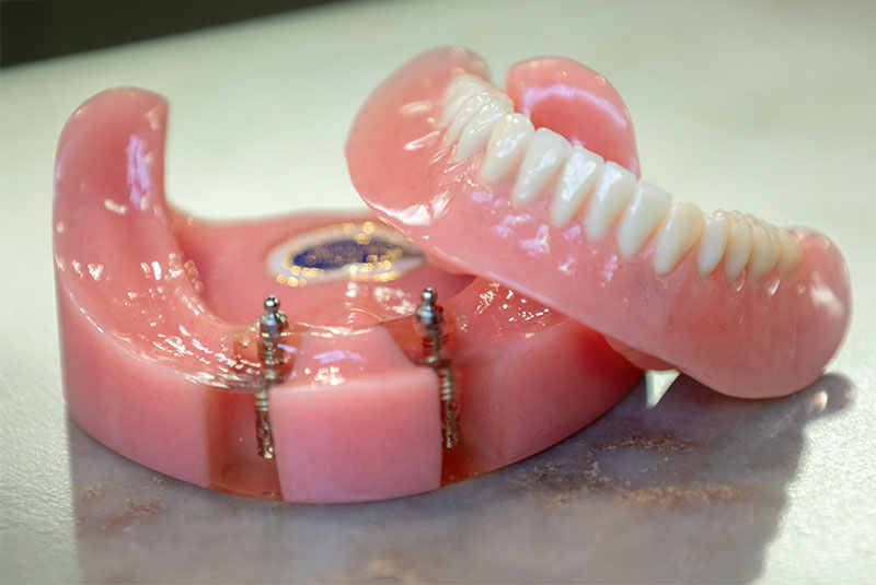 implant supported denture