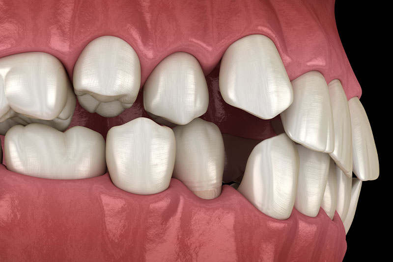 malocclusion