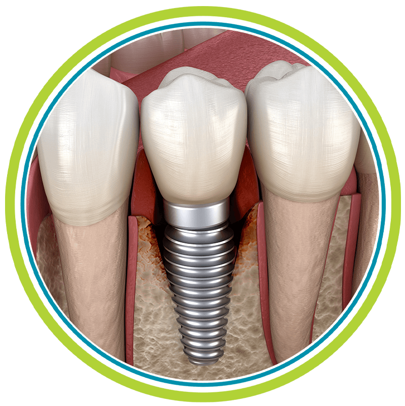 failing dental implant cir