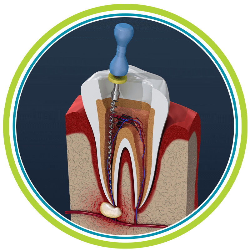 root canal 3d
