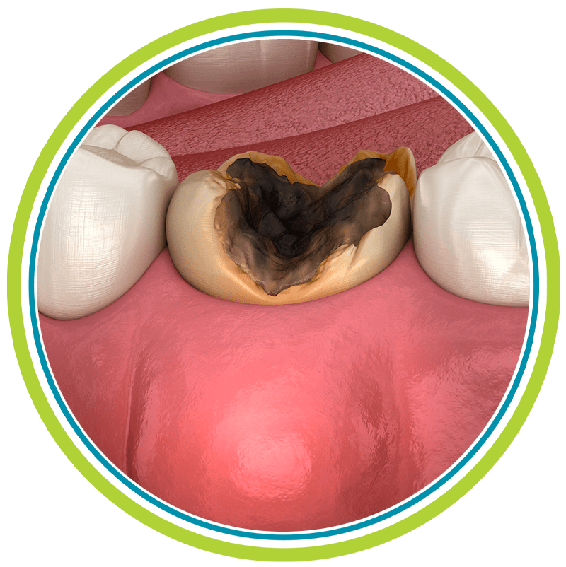 tooth abscess 3d