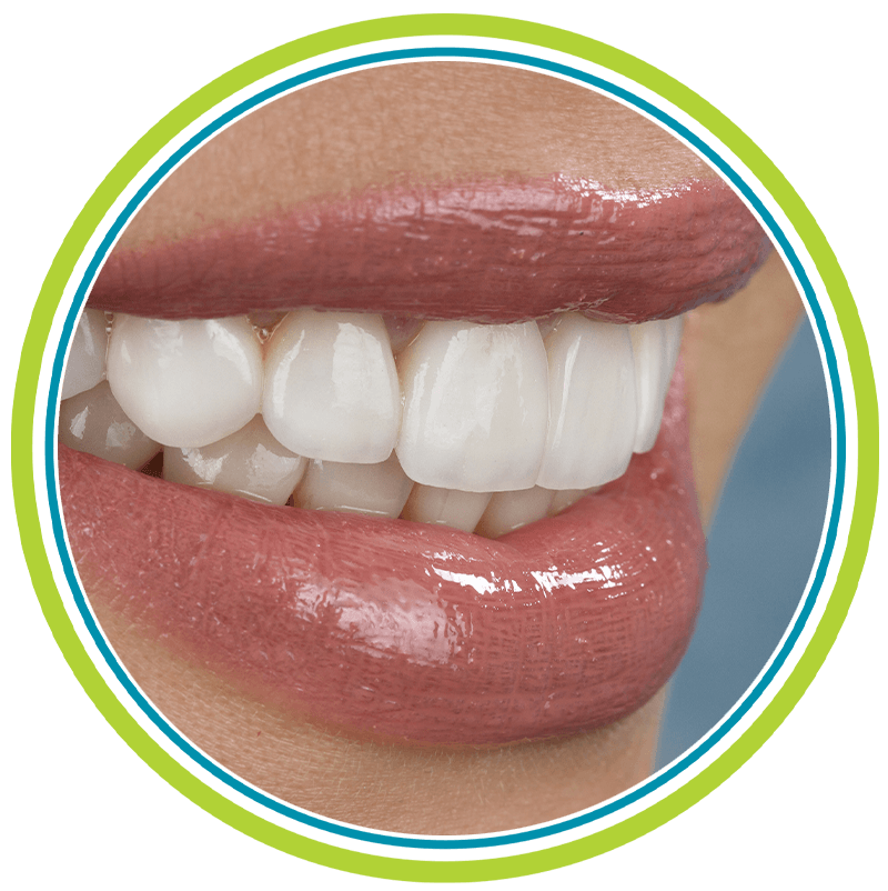 close up of veneers